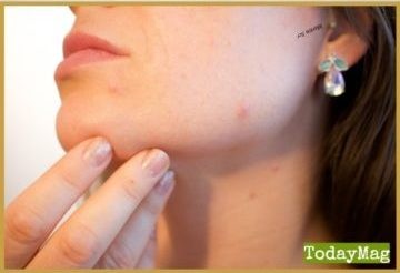Effectively Homemade Cream to Make Your Acne Scars Disappear!!!