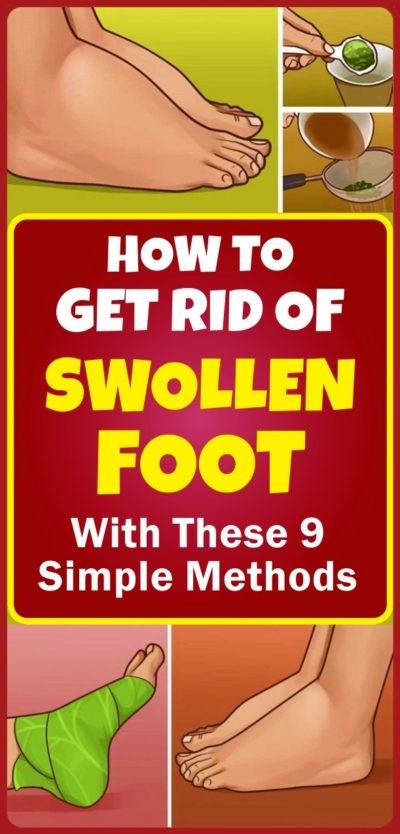 How-to-get-rid-of-swollen-foot-with-these-9-methods